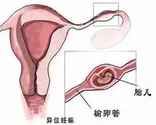 代孕有哪几种_代孕可以在医院做吗_b超和甲胎蛋白哪个准